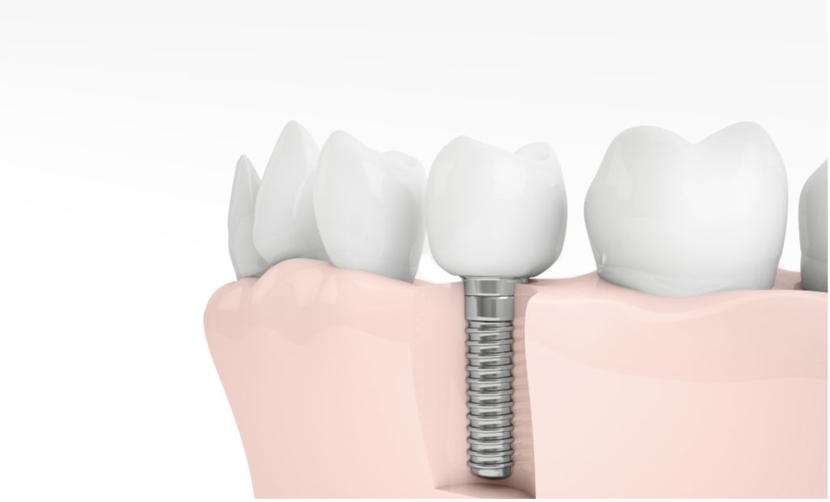 Rizici i komplikacije zubnih implantata: Kako ih izbjeći