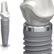 Zašto dolazi do odbacivanja implantata?