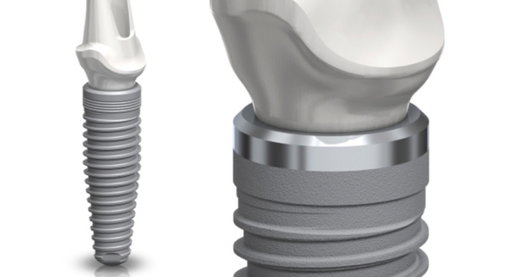 Zašto dolazi do odbacivanja implantata?