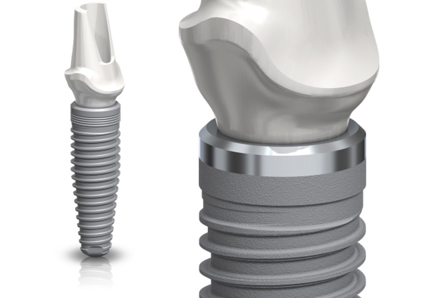 Zašto dolazi do odbacivanja implantata?