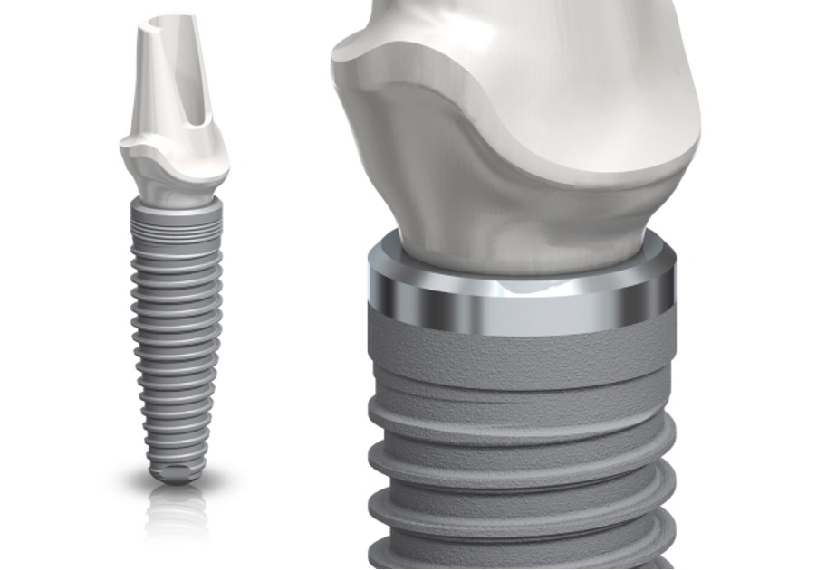 Zašto dolazi do odbacivanja implantata?
